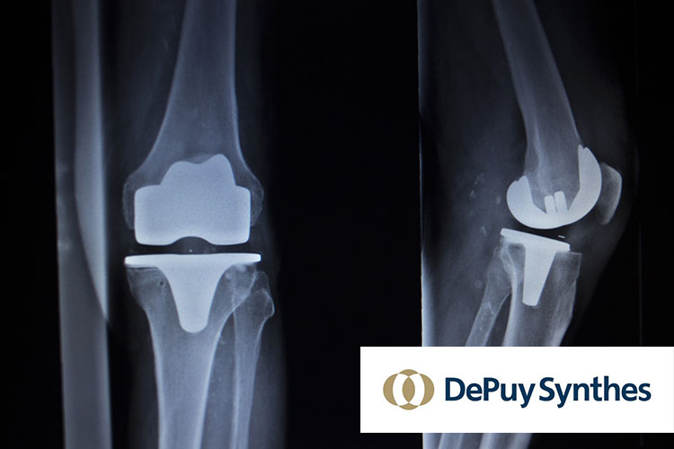 DePuy Touts Benefits of Attune Knee Despite High Failure Rates