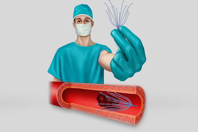 Federal Jury Finds IVC Filter Dangerous, Defective, Returns $3M Verdict Against Cook Medical